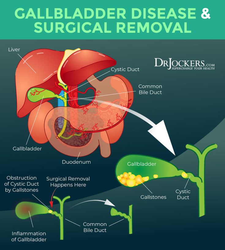 No Gallbladder Strategies To Improve Digestive Health